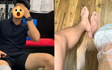 Tình trạng nghiêm trọng của nam thần VFC sau 1 năm bị đứt dây chằng chéo trước