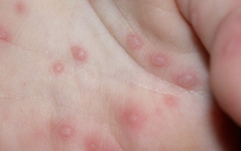 Sau 2 ngày nổi hồng ban, bé trai 2 tuổi nguy kịch vì căn bệnh này