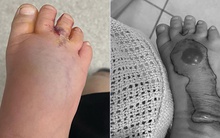 Chỉ một vết mèo cào tưởng vô hại, em bé phải cắt bỏ một phần chân khiến phụ huynh sợ hãi