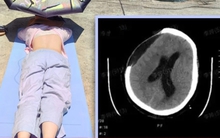 Tắm nắng cho khỏe, người phụ nữ bị xuất huyết não, hôn mê