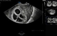 Cực hiếm gặp: Bệnh viện Phụ Sản Hà Nội ghi nhận 1 sản phụ mang thai 4 tự nhiên, tỷ lệ chỉ khoảng 1/700.000 - 800.000 ca