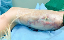 Tiêm filler toàn thân, cô gái trẻ hoại tử đùi, trải qua 60 ca mổ khóc lóc cầu cứu bác sĩ: "Khâu lại giúp, con đau lắm"