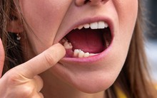 Nhật Bản thử nghiệm thuốc mọc lại răng cho người lớn, dự kiến 2030 sẽ bán ra