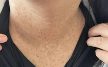 Uống thuốc chữa táo bón suốt 2 năm, người phụ nữ ngộ độc chất asen mà không biết!