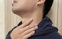 Uống 5 lon nước ngọt mỗi ngày, nam thanh niên trào ngược dạ dày 98 lần