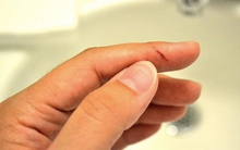 4 người 1 nhà cùng nhiễm khuẩn tụ cầu vàng sau bữa tối, bác sĩ chỉ đích danh người nấu là "thủ phạm"