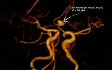 Đau đầu kéo dài, cô gái Hà Nội đi khám phát hiện phình mạch não, suýt đột quỵ