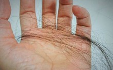 Một phụ nữ giảm được 10kg nhưng lại bị hói đầu: Bác sĩ tiết lộ 4 nguyên nhân chính không ai ngờ