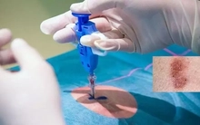 Ung thư da: Nguy hiểm tiềm ẩn từ những tổn thương không đau, không ngứa