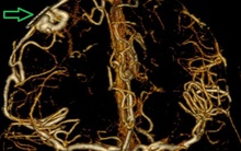 Bác sĩ cảnh báo “quả bom nổ chậm” trong não: Người trẻ dễ chủ quan với dấu hiệu này