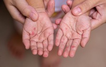 Ba tháng đầu năm ghi nhận gần 25.000 ca tay chân miệng, Bộ Y tế chỉ đạo khẩn