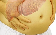 Nhiều người Việt xơ gan, ung thư gan chỉ vì dùng 1 thứ tưởng "lành tính": Bác sĩ cảnh báo