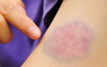 5 dấu hiệu nhỏ trên da "tố cáo" bệnh gan, nhiều người dễ xem thường