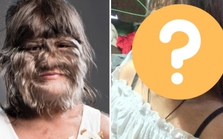 "Cô bé người sói" mắc chứng bệnh lạ cả thế giới chỉ có 50 người từng bị giờ ra sao ở tuổi trưởng thành?