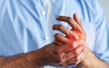 Dấu hiệu ung thư có thể xuất hiện trên bàn tay, cực dễ bỏ sót Dấu hiệu ung thư có thể xuất hiện trên bàn tay, cực dễ bỏ sót
