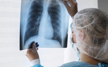 Tưởng chỉ cảm lạnh, người đàn ông bất ngờ nhận tin ung thư phổi: Triệu chứng cảnh báo hơn 1 tuần nhưng bị bỏ qua