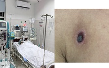 4 ngày xuất hiện nốt ruồi đen trên ngực, người đàn ông bất ngờ sốt cao, phải vào viện cấp cứu vì suy đa tạng, lọc máu liên tục: Cảnh báo căn bệnh dễ gặp khi đi du lịch