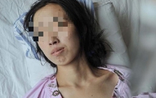 Đi khám vì khó tiêu, người phụ nữ phát hiện ung thư gan: BS hoảng hốt: "Ai lại ăn sáng kiểu này suốt 20 năm?"