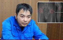 Cựu nhân viên y tế đục vỡ xương trục lợi bảo hiểm: Thủ đoạn tàn nhẫn, bất nhân