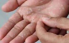 Khổ cả mùa đông vì da tay da chân bong tróc: Thói quen nhiều người vẫn làm mà không nhận ra đang tự làm đau mình