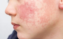 8 dấu hiệu ban đầu của "căn bệnh dễ lây lan nhất thế giới": Xuất hiện TRƯỚC cả khi phát ban, trẻ dưới 5 tuổi có nguy cơ cao nhất