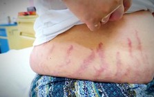 "Con tôi chỉ bị viêm mũi dị ứng thôi mà...": Người mẹ khóc nấc vì không ngờ thói quen xịt mũi lại khiến con bị suy tuyến thượng thận