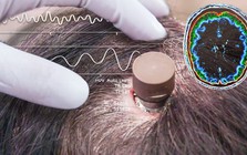 Người đàn ông bị liệt chỉnh sửa video, đăng YouTube 'chỉ bằng suy nghĩ': Ca cấy chip não Neuralink thứ ba gây chấn động