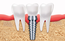 Sau khi cắm implant cần nghỉ ngơi bao lâu?