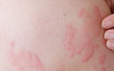 Bác sĩ chỉ ra sai lầm “chết người” về một căn bệnh mà nhiều người vẫn vô tư điều trị tại nhà