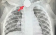 Bé trai 1 tuổi bỏ ăn cả tuần, nguyên nhân được phát hiện khiến bà nội phải thốt lên: “Đúng là lỗi của tôi”