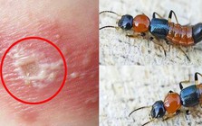Kiến ba khoang "vào mùa", cẩn trọng dễ nhầm với zona thần kinh
