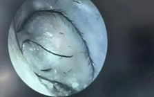 Người phụ nữ ngứa tai đi khám, bác sĩ phát hiện thứ bất ngờ bên trong