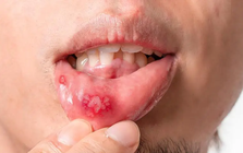 Cơ thể bạn không biết nói dối: 3 dấu hiệu phổ biến của hệ miễn dịch suy yếu, hãy xem bạn có bao nhiêu trong số đó