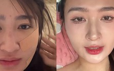 Mỹ nhân SN 2001 đóng phim giờ vàng VTV công khai dung mạo sau khi hút mỡ mặt
