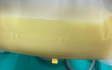 Người phụ nữ 32 tuổi máu "trắng đục như sữa", bác sĩ "chỉ mặt điểm tên" thói quen ít ai ngờ