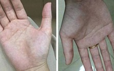 Bàn tay là tín hiệu cảnh báo sức khỏe: 1 thay đổi có thể cho thấy bệnh tiểu đường hoặc xơ gan