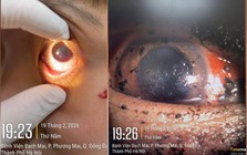 Bệnh viện Bạch Mai cảnh báo 1 tình trạng bệnh ở mắt tăng vọt ngay trong 3 ngày đầu năm 2026