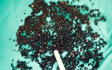 5000 viên sỏi lấp kín túi mật người đàn ông: Bác sĩ nói thẳng: "3 thói quen này là nguyên nhân"