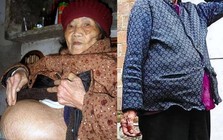 Cụ bà 91 tuổi ngã khi đi lấy nước, vào viện thì phát hiện “mang thai”: Bí mật về "bào thai hoá đá"