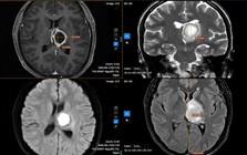 Thường xuyên buồn ngủ, đi khám “sốc” nặng khi biết nguyên nhân