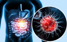 Ung thư đại trực tràng gia tăng đáng báo động: 4 dấu hiệu ở xa “tít tắp” có thể cảnh báo sớm