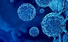 Loại ung thư đứng thứ 2 về tỉ lệ tử vong tại Việt Nam: 5 dấu hiệu sớm nhất ai cũng nên biết