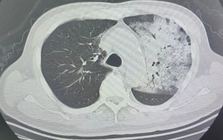 Người đàn ông sốt 40 độ C, phổi gần như 'trắng xóa", chỉ vài ngày đã suy đa tạng: Thủ phạm liên quan đến thói quen nhiều gia đình vẫn mắc