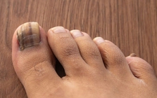Dấu hiệu ở móng chân cảnh báo loại ung thư nguy hiểm: Nhiều người bỏ qua, bác sĩ khẩn thiết nhắc nhở