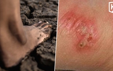 Thái Lan cảnh báo khẩn về dịch "sốt đất": 732 ca nhiễm, 23 trường hợp tử vong