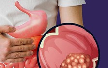 Phát hiện ung thư giai đoạn 4 ở tuổi 26, nam thanh niên hối hận: Giá như tôi không bỏ qua triệu chứng này