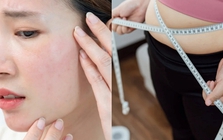 Không phải do bạn lười tập: Đây mới là lý do khiến nhiều người không thể "đốt mỡ", càng giảm cân càng thấy mụn