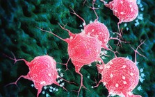 Tác nhân “châm ngòi” cho hàng nghìn ca ung thư nhưng ít ai để ý