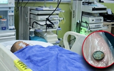 Bé trai 3 tuổi nuốt phải pin cúc áo, mẹ cho uống ngay 1 thìa gia vị, đến bệnh viện bác sĩ khen: "Giỏi lắm"