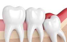 Nhổ răng khôn có được BHYT chi trả?